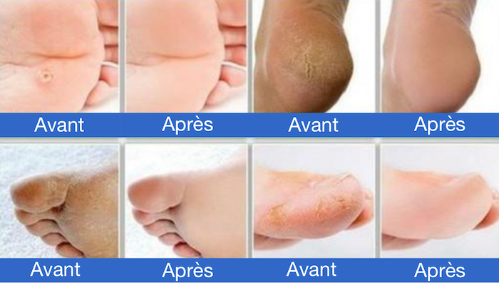 APPAREIL DE NETTOYAGE DES PIEDS : HTC ORIGINALE PÉDISILK.